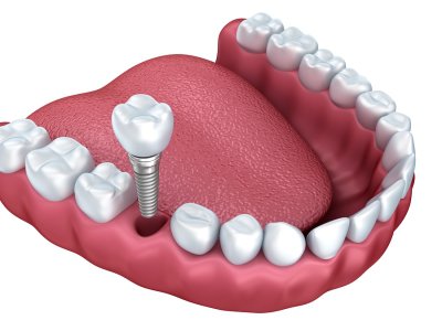 Implant Dentistry Hazlet